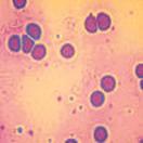 Vista microscópica del sudor de una persona para detectar la Fibrosis Quística