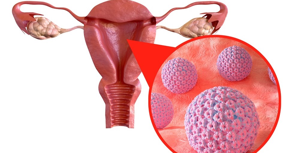 representación del VPH, un aparato reproductor femenino y un zoom a la zona del cuello uterino con una representación de virus azules
