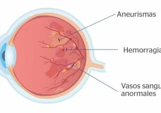 proceso explicativo de la retinopatía diabética